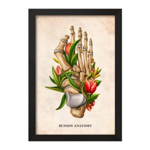 تابلو آناتومی بونیون (Bunion Anatomy)